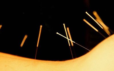 Can acupuncture treat PCOS?