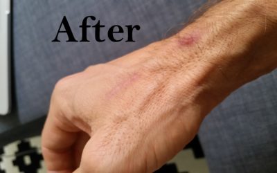Scar therapy with our RJ Physio Laser after 6 sessions, here are the results:
