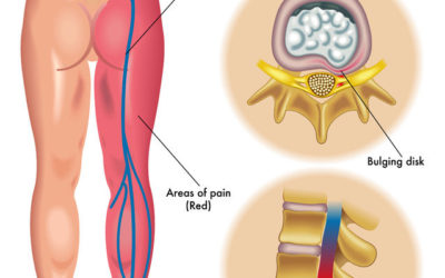 Solution for Sciatica