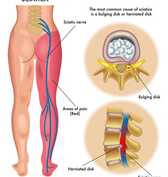 Solution for Sciatica