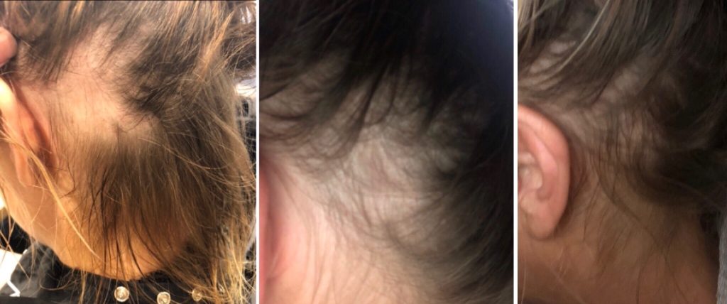 Alopecia treatment with TCM | Eastern Therapies Alopecia treatment with TCM | Eastern Therapies