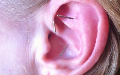 Ear Acupuncture