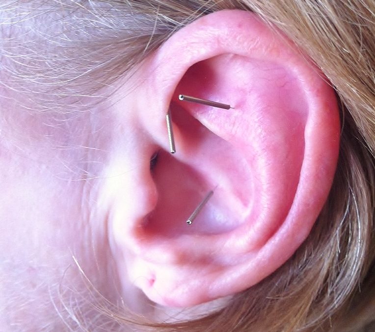 Ear Acupuncture