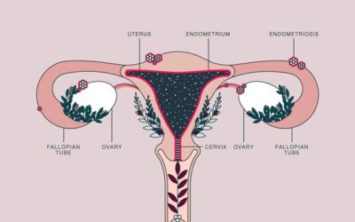 What is Endometriosis?