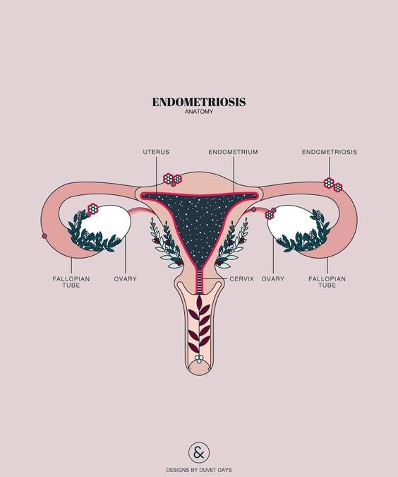 What is Endometriosis?