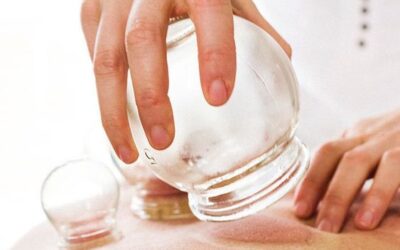 Cupping and Cellulite