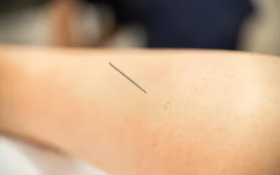Dry Needling vs Acupuncture: All You Need To Know