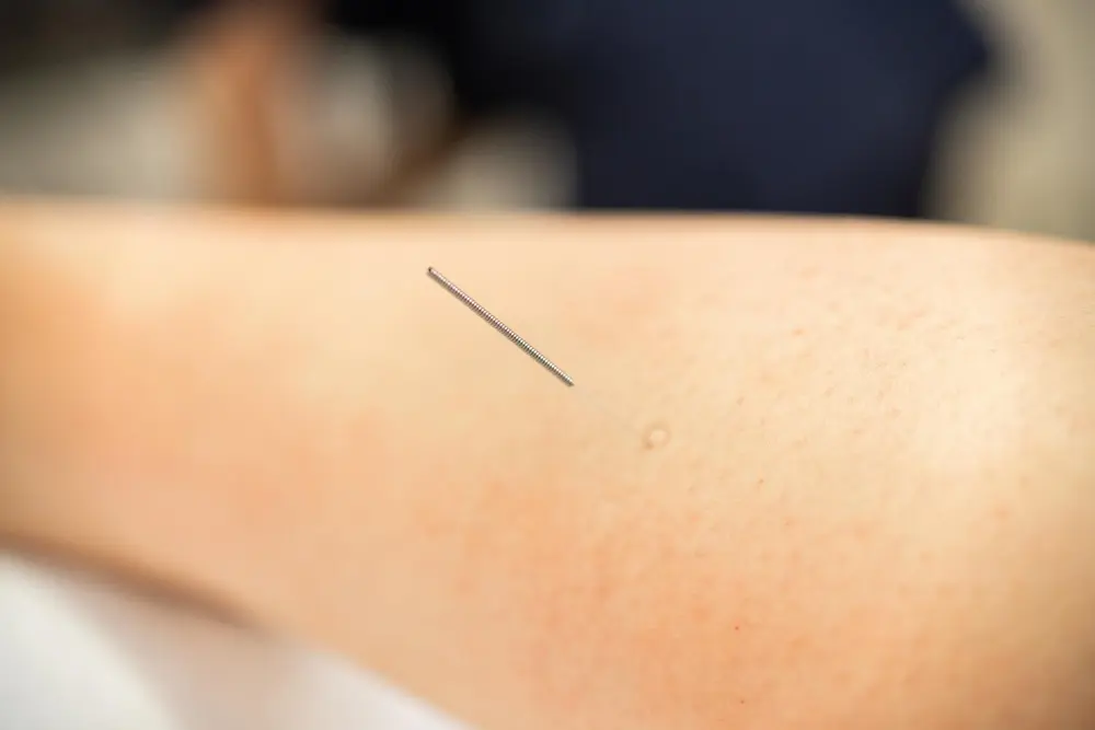 Dry Needling vs Acupuncture: All You Need To Know