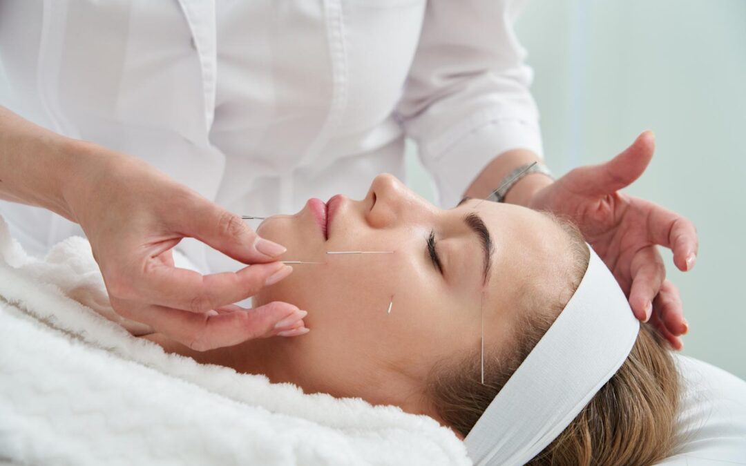 Can Acupuncture Help with Stress? Eastern Therapies