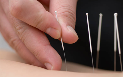 Unlocking Relief: The Power of Neurological Acupuncture for Trapped Nerves