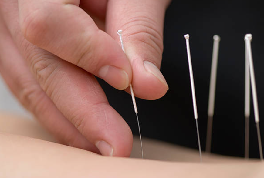Unlocking Relief: The Power of Neurological Acupuncture for Trapped Nerves