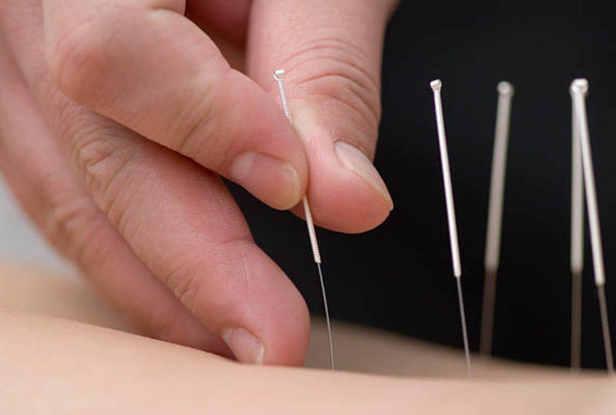 Neurological Acupuncture