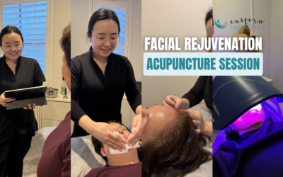 What to Expect During a Facial Rejuvenation Acupuncture Session